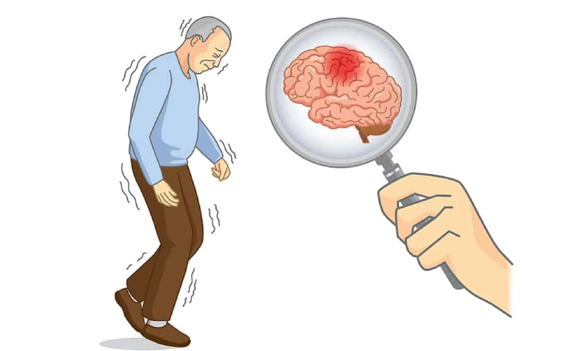 điều trị parkinson bằng tế bào gốc