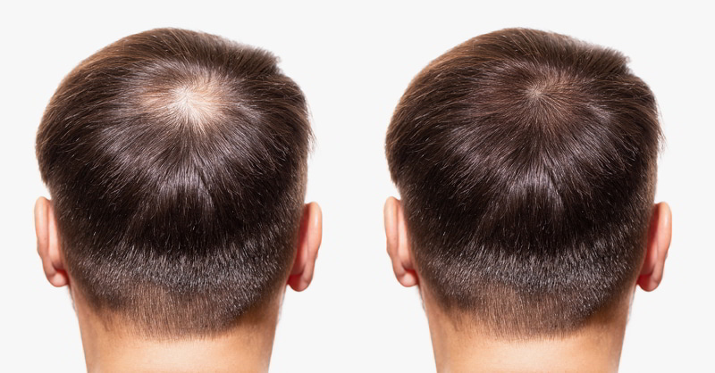 tác dụng của exosome trong điều trị kích thích mọc tóc