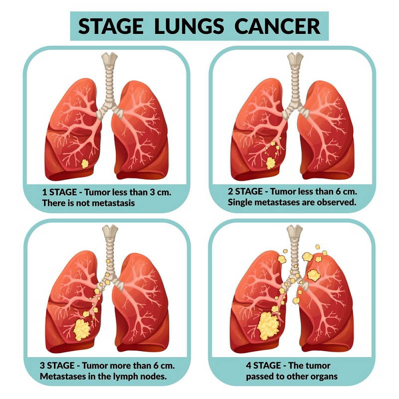 Bệnh ung thư phổi sống được bao lâu theo giai đoạn