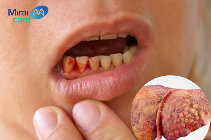 Ung thư gan gây thiếu máu, dấu hiệu của biến chứng này là chảy máu chân răng