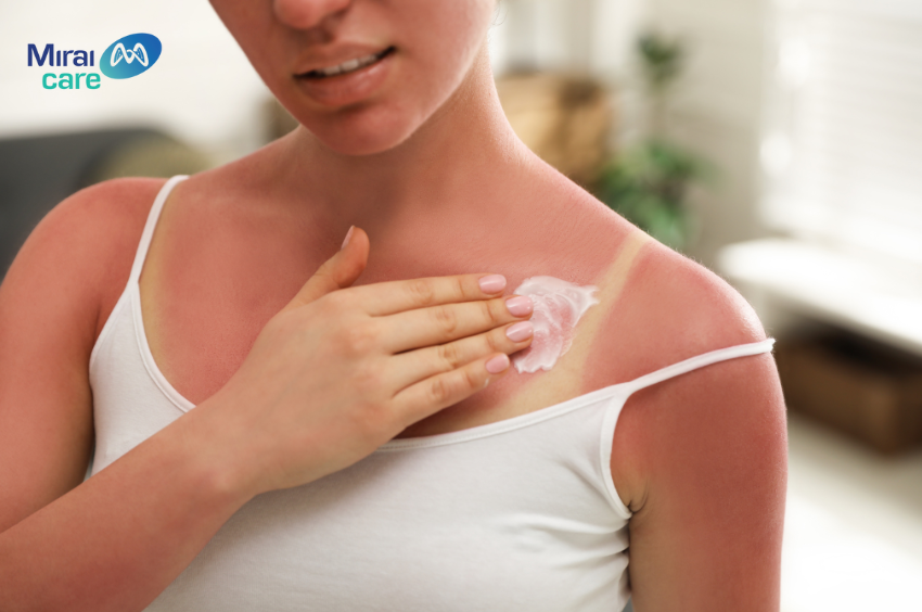 Da bị cháy nắng chủ yếu cho tia UV trong ánh nắng mặt trời 