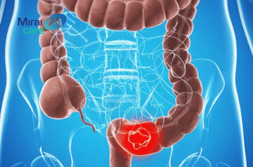 đau bụng là dấu hiệu ung thư đại tràng giai đoạn 1