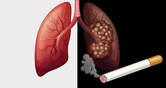 ung thư phổi ở nam giới