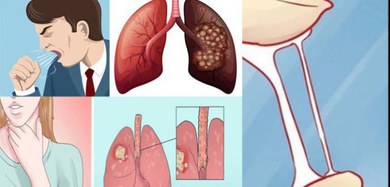 dấu hiệu ung thư phổi ở nam giới