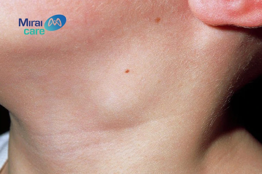 dấu hiệu ung thư vòm họng phổ biến