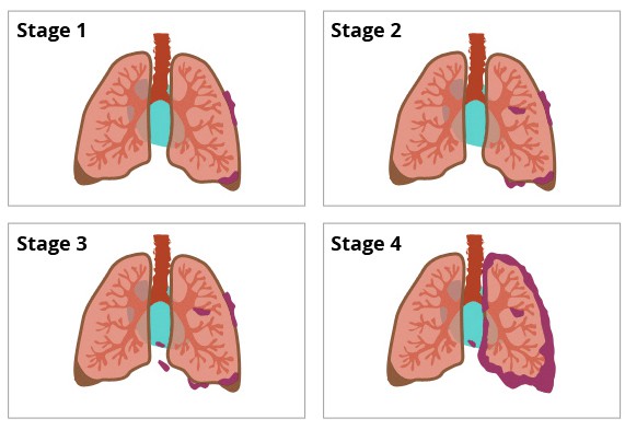 Các giai đoạn ung thư phổi