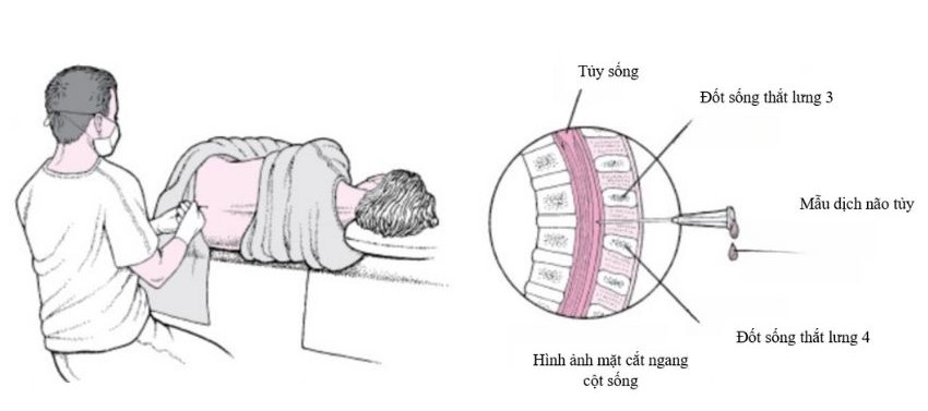 Hình ảnh mô phỏng quy trình và chọc dò tủy xương