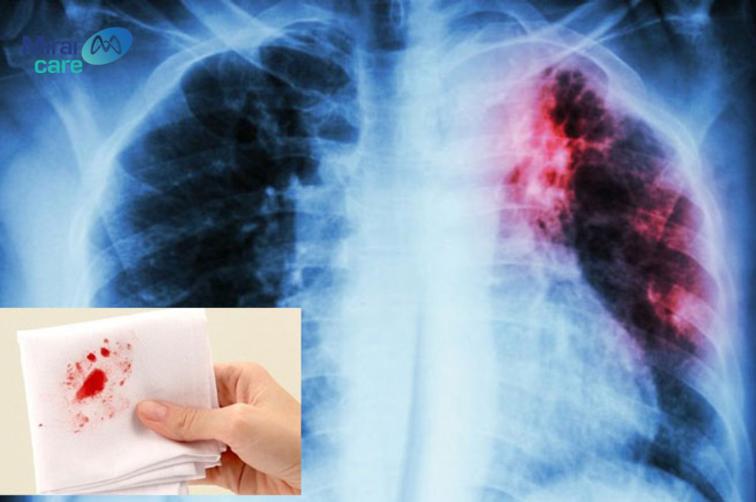 Ho ra máu là một trong những triệu chứng của ung thư phổi