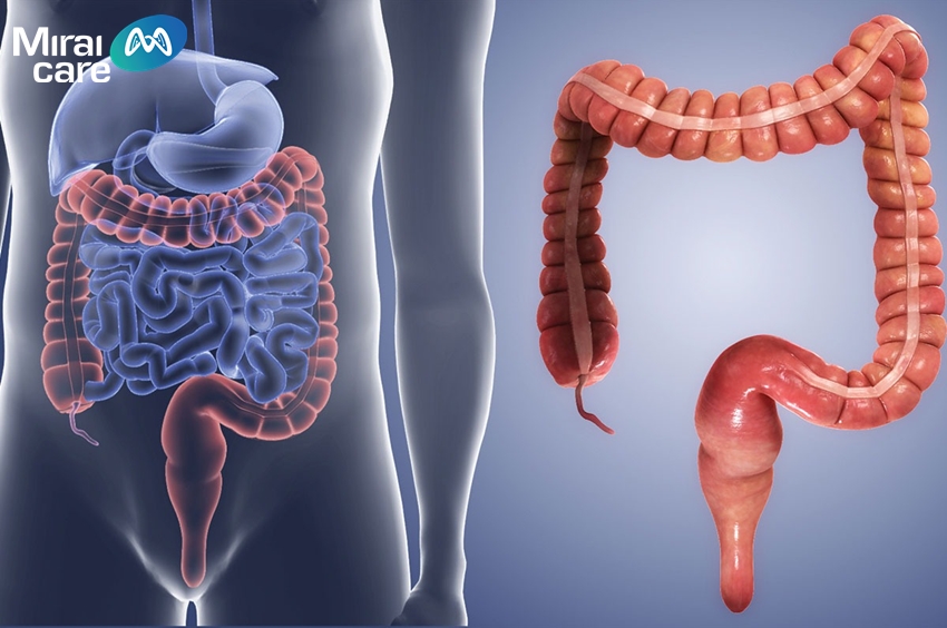 Hội chứng rò rỉ ruột là tình trạng mà lớp niêm mạc ruột bị tổn thương, trở nên “kém chọn lọc”