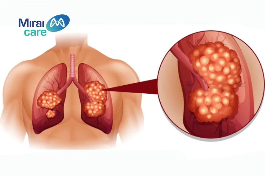 liệu pháp miễn dịch điều trị ung thư phổi