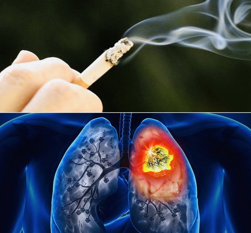 Nguyên nhân gây ung thư phổi