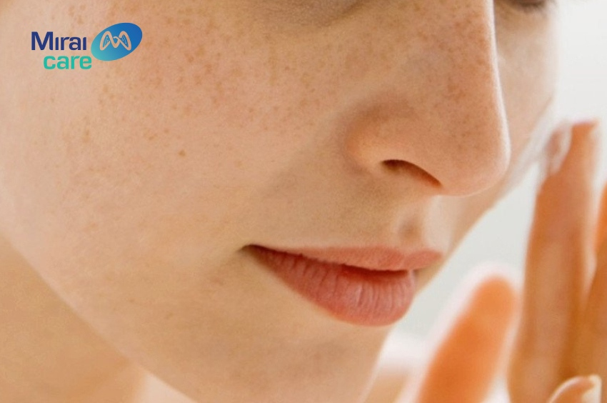 Sự rối loạn nội tiết cùng các yếu tố bên ngoài dẫn đến tình trạng nám da ở phụ nữ