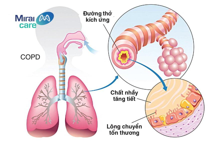tế bào gốc điều trị bệnh phổi tắc nghẽn mãn tính
