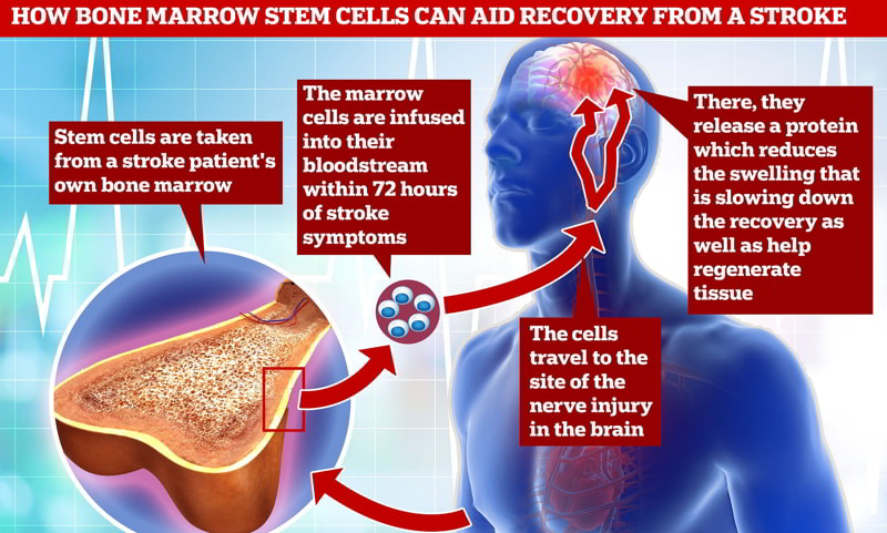 Hiệu quả của tế bào gốc tủy xương trong điều trị đột quỵ