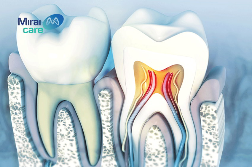 ứng dụng tế bào gốc tái tạo tủy răng