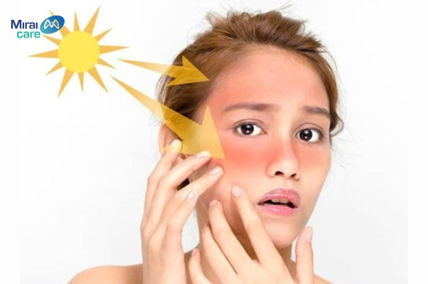 Tia UV từ ánh nắng mặt trời gây ra tình trạng nám da nghiêm trọng