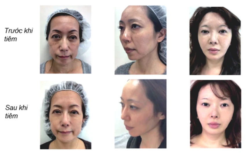 Hình ảnh trước và sau tiêm tế bào gốc Nhật bản của khách hàng tại Mirai Care