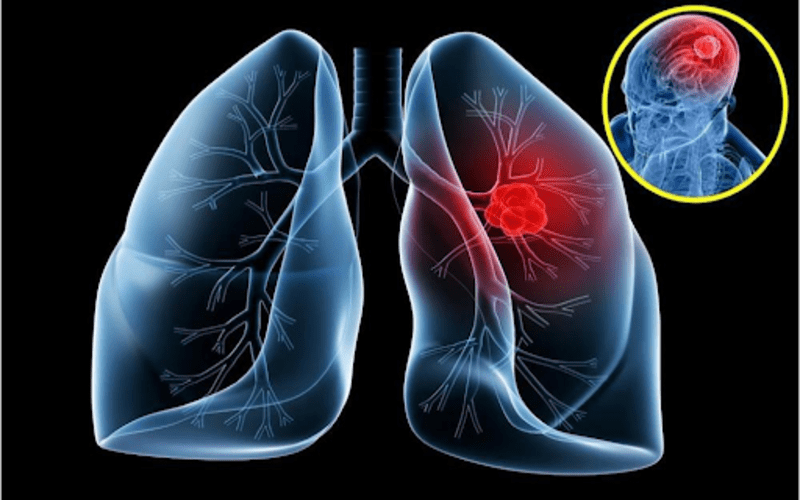 ung thư phổi gây hiện tượng đau đầu