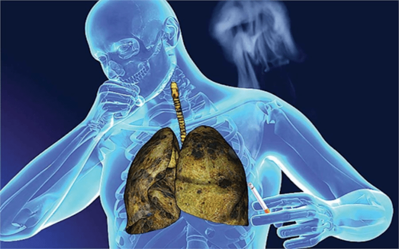 triệu chính ung thư phổi