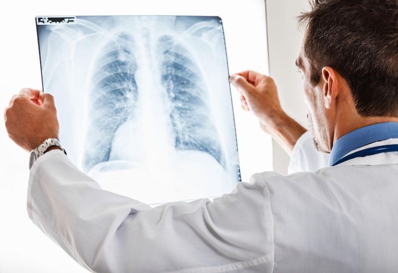 Ung thư phổi có chữa được không