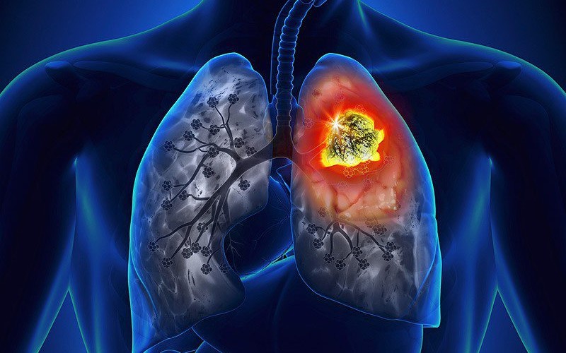 ung thư phổi có di truyền không