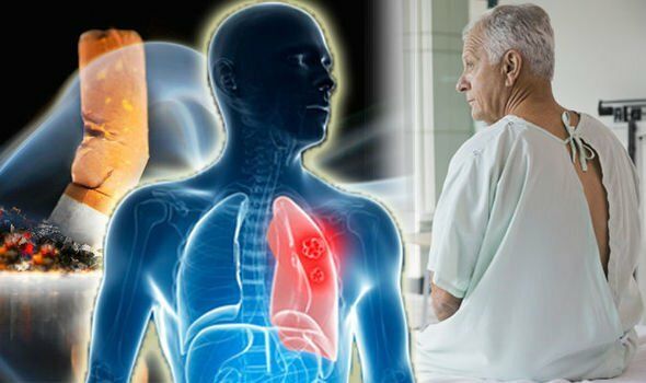 Người bệnh ung thư phổi giai đoạn 2 sống được bao lâu