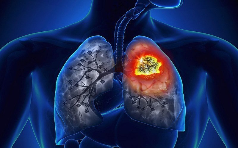 Ung thư phổi giai đoạn 3 sống được bao lâu