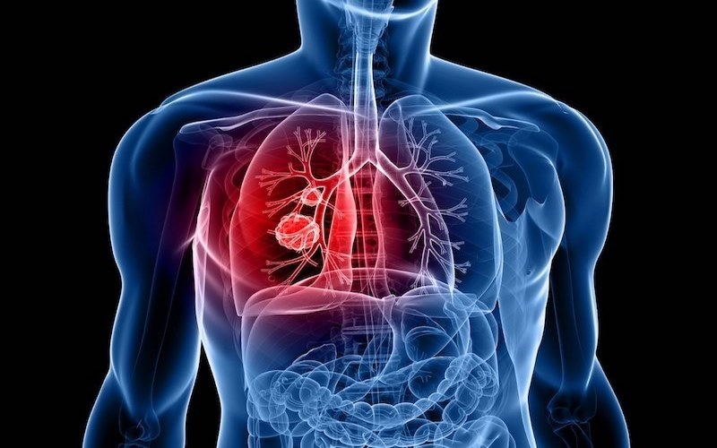 Ung thư phổi giai đoạn 3 sống được bao lâu
