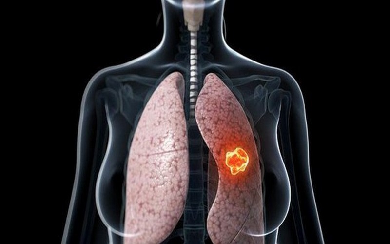 ung thư phổi giai đoạn 3A sống được bao lâu