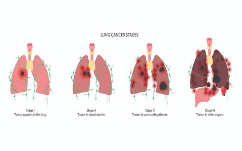 diễn biễn bệnh nhân ung thư phổi giai đoạn 4