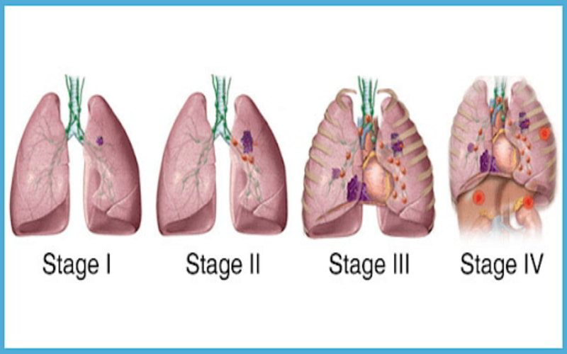 Ung thư phổi giai đoạn 4 sống được bao lâu