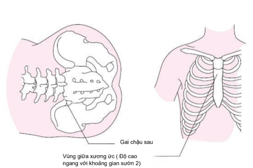 Vị trí chọc dò tủy xương