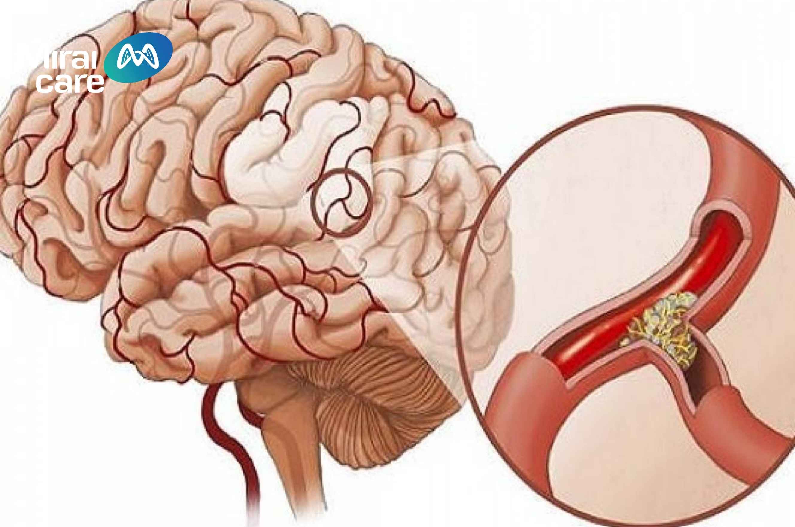 xuất huyết não ở trẻ là nguyên nhân hàng đầu dẫn đến bệnh bại não