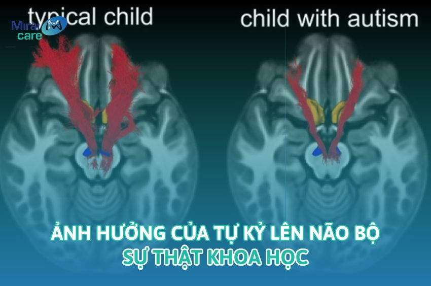 Tự Kỷ