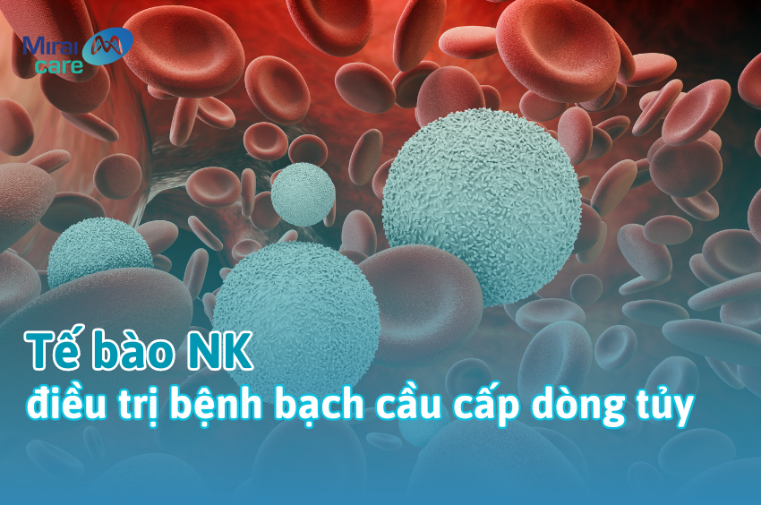 Liệu pháp tế bào NK trong điều trị bệnh bạch cầu cấp dòng tủy