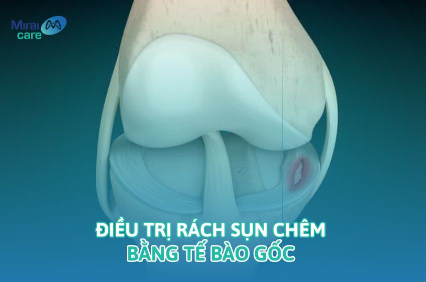 Điều Trị Rách Sụn Chêm Bằng Tế Bào Gốc: Hiệu Quả, Chi Phí