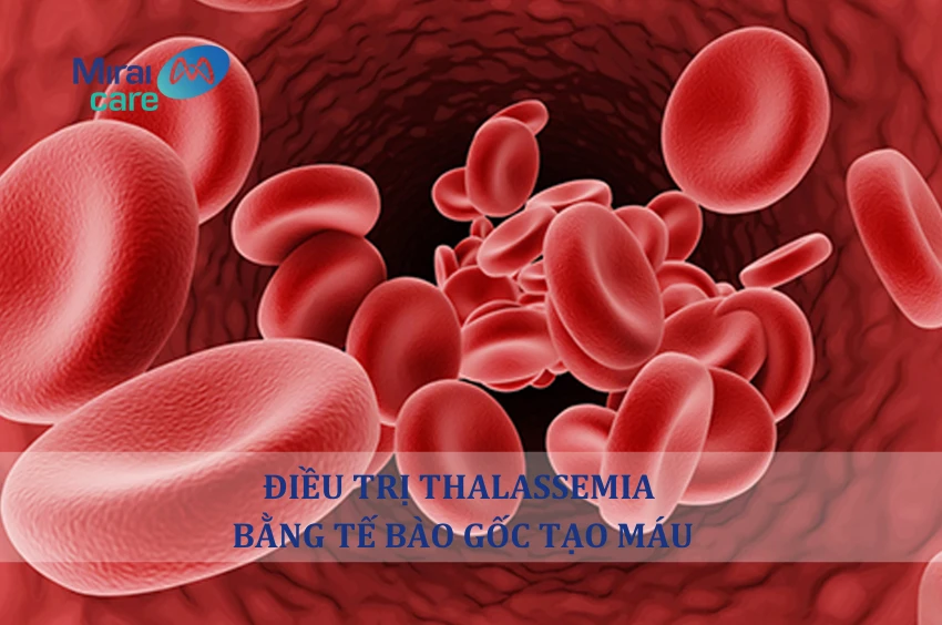 Điều trị Thalassemia bằng phương pháp ghép tế bào gốc tạo máu