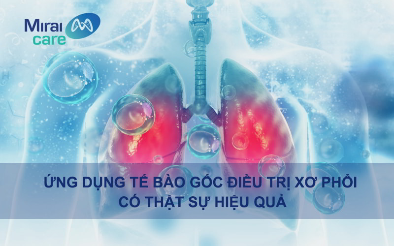 Liệu pháp tế bào gốc điều trị bệnh xơ phổi