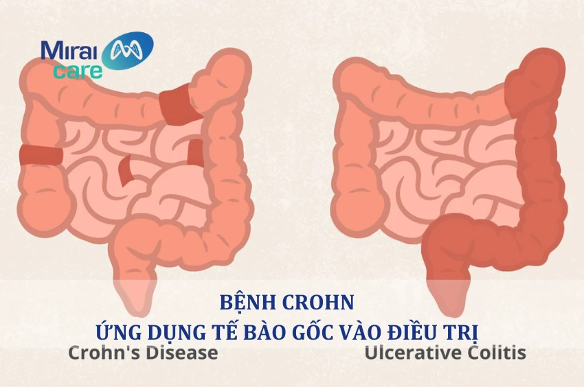 Ứng dụng tế bào gốc trong điều trị bệnh Crohn