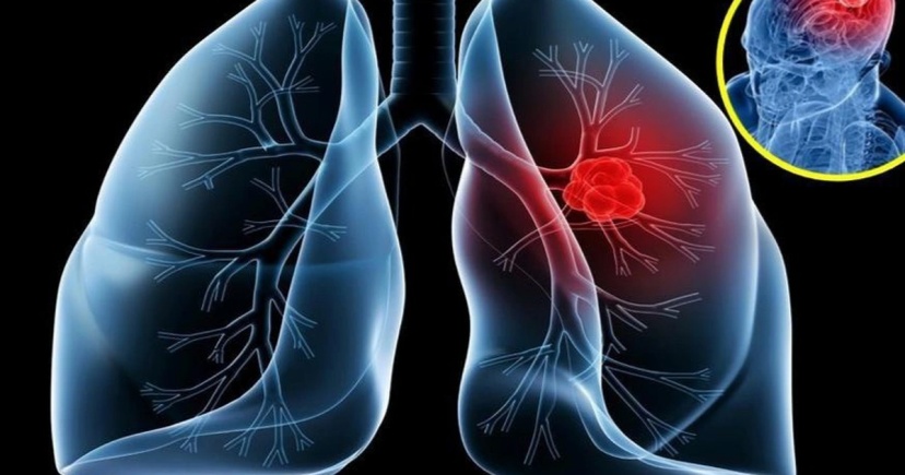 Ung thư phổi giai đoạn 1 sống được bao lâu?