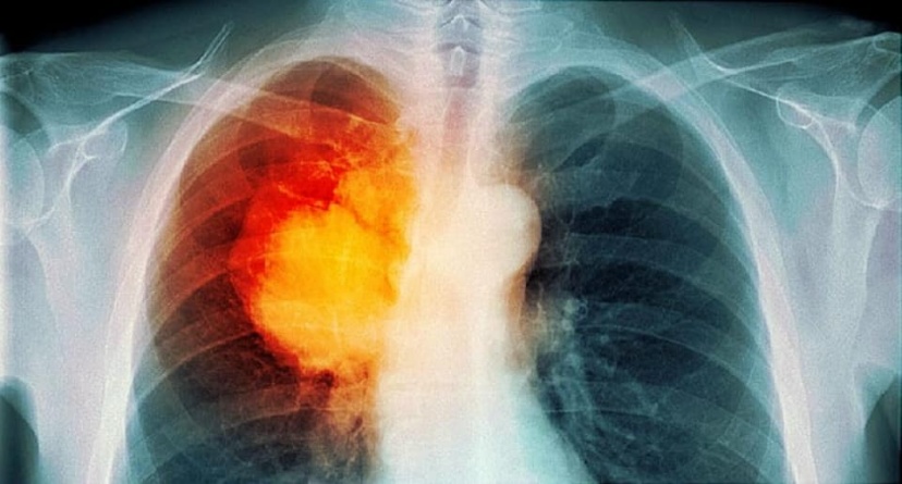 Giải đáp: Ung thư phổi giai đoạn 3 sống được bao lâu?