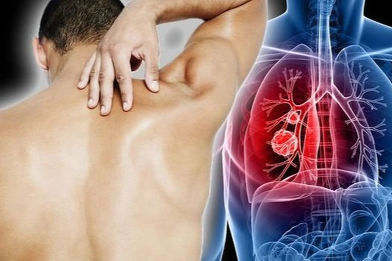 Ung thư phổi giai đoạn đầu có chữa được không?
